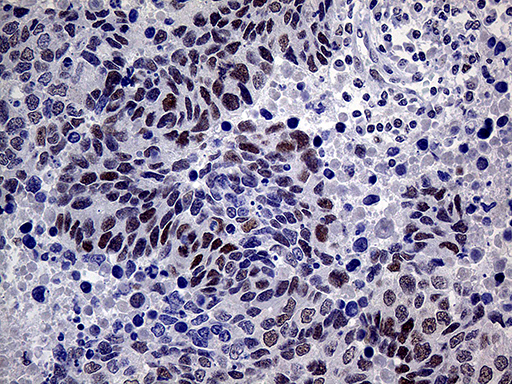 MLH1 Antibody - Immunohistochemical staining of paraffin-embedded Carcinoma of Human lung tissue using anti-MLH1 mouse monoclonal antibody. (Heat-induced epitope retrieval by 1mM EDTA in 10mM Tris buffer. (pH8.5) at 120°C for 3 min. (1:1000)