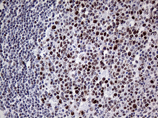 MLH1 Antibody - Immunohistochemical staining of paraffin-embedded Human lymph node tissue within the normal limits using anti-MLH1 mouse monoclonal antibody. (Heat-induced epitope retrieval by 1mM EDTA in 10mM Tris buffer. (pH8.5) at 120°C for 3 min. (1:1000)