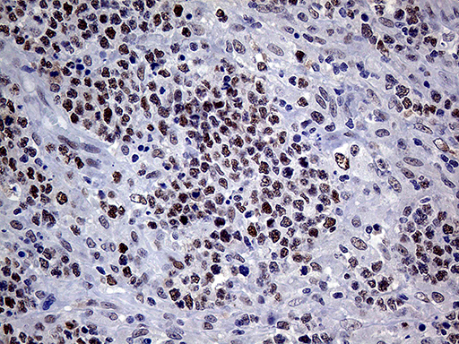MLH1 Antibody - Immunohistochemical staining of paraffin-embedded Human lymphoma tissue using anti-MLH1 mouse monoclonal antibody. (Heat-induced epitope retrieval by 1mM EDTA in 10mM Tris buffer. (pH8.5) at 120°C for 3 min. (1:1000)