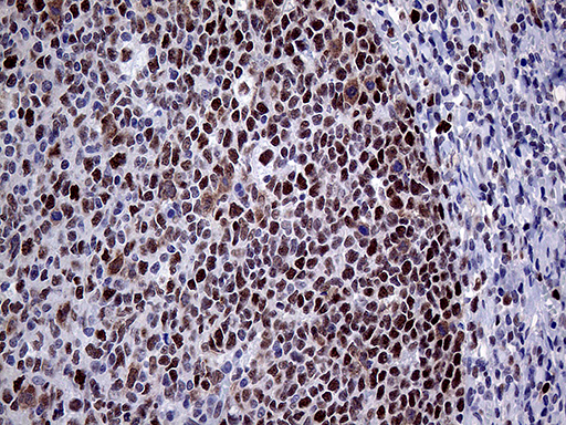 MLH1 Antibody - Immunohistochemical staining of paraffin-embedded Human tonsil within the normal limits using anti-MLH1 mouse monoclonal antibody. (Heat-induced epitope retrieval by 1mM EDTA in 10mM Tris buffer. (pH8.5) at 120°C for 3 min. (1:1000)