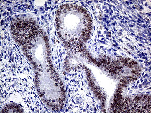 MLH1 Antibody - Immunohistochemical staining of paraffin-embedded Human endometrium tissue within the normal limits using anti-MLH1 mouse monoclonal antibody. (Heat-induced epitope retrieval by 1mM EDTA in 10mM Tris buffer. (pH8.5) at 120°C for 3 min. (1:500)