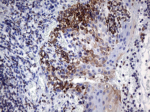 MLH1 Antibody - Immunohistochemical staining of paraffin-embedded Human tonsil within the normal limits using anti-MLH1 mouse monoclonal antibody. (Heat-induced epitope retrieval by 1mM EDTA in 10mM Tris buffer. (pH8.5) at 120°C for 3 min. (1:500)