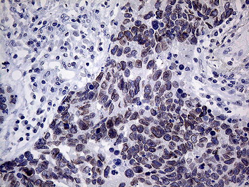 MLH1 Antibody - Immunohistochemical staining of paraffin-embedded Carcinoma of Human lung tissue using anti-MLH1 mouse monoclonal antibody. (Heat-induced epitope retrieval by 1mM EDTA in 10mM Tris buffer. (pH8.5) at 120°C for 3 min. (1:500)