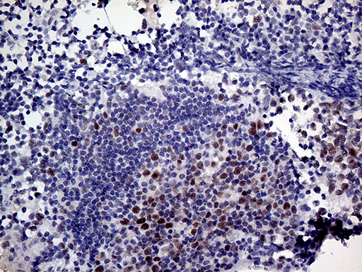 MLH1 Antibody - Immunohistochemical staining of paraffin-embedded Human lymph node tissue within the normal limits using anti-MLH1 mouse monoclonal antibody. (Heat-induced epitope retrieval by 1mM EDTA in 10mM Tris buffer. (pH8.5) at 120°C for 3 min. (1:150)