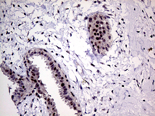 MLH1 Antibody - Immunohistochemical staining of paraffin-embedded Human breast tissue within the normal limits using anti-MLH1 mouse monoclonal antibody. (Heat-induced epitope retrieval by 1mM EDTA in 10mM Tris buffer. (pH8.5) at 120°C for 3 min. (1:150)
