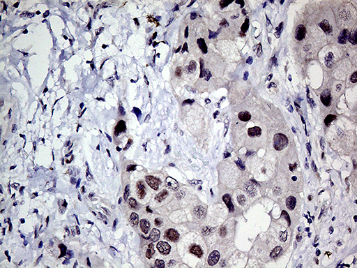 MLH1 Antibody - Immunohistochemical staining of paraffin-embedded Adenocarcinoma of Human breast tissue tissue using anti-MLH1 mouse monoclonal antibody. (Heat-induced epitope retrieval by 1mM EDTA in 10mM Tris buffer. (pH8.5) at 120°C for 3 min. (1:150)