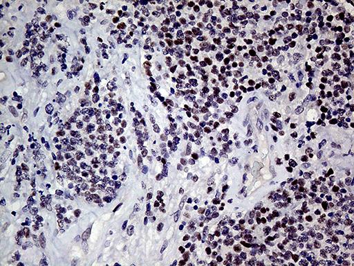 MLH1 Antibody - Immunohistochemical staining of paraffin-embedded Human lymphoma tissue using anti-MLH1 mouse monoclonal antibody. (Heat-induced epitope retrieval by 1mM EDTA in 10mM Tris buffer. (pH8.5) at 120°C for 3 min. (1:150)