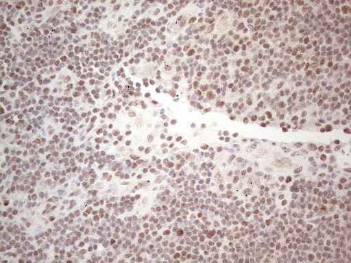 MLH1 Antibody - Immunohistochemical staining of paraffin-embedded Carcinoma of Human lung tissue using anti-MLH1 mouse monoclonal antibody. (Heat-induced epitope retrieval by 1mM EDTA in 10mM Tris buffer. (pH8.0) at 110C for 10 min. (1:200)