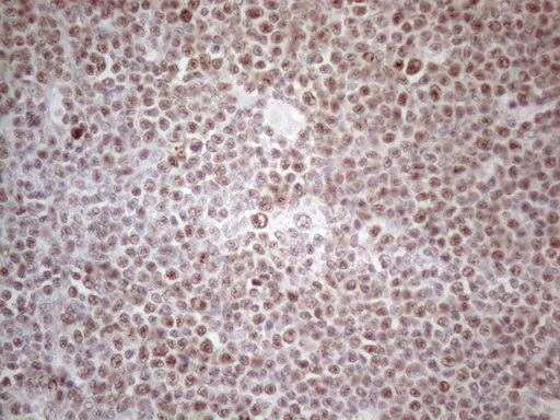 MLH1 Antibody - Immunohistochemical staining of paraffin-embedded Human lymphoma tissue using anti-MLH1 mouse monoclonal antibody. (Heat-induced epitope retrieval by 1mM EDTA in 10mM Tris buffer. (pH8.0) at 110C for 10 min. (1:200)