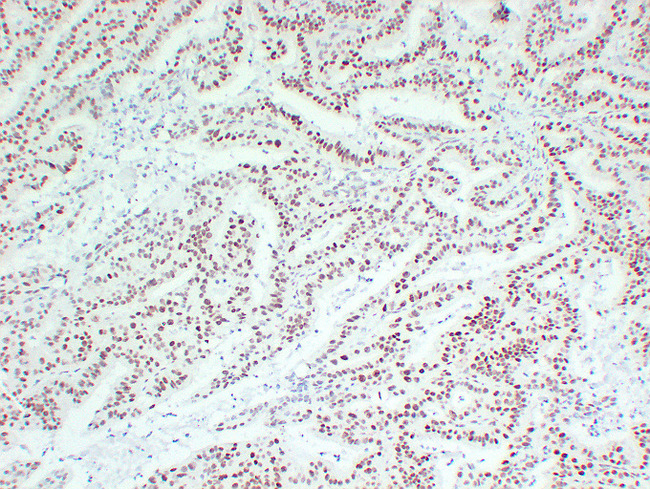 MLH1 Antibody - Colon Carcinoma 1