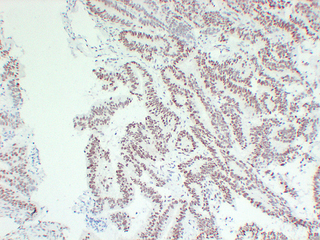 MLH1 Antibody - Colon Carcinoma 2