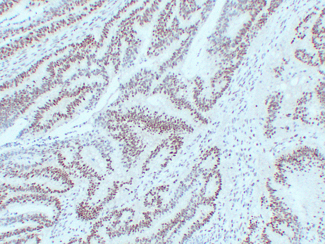 MLH1 Antibody - Colon Carcinoma 3
