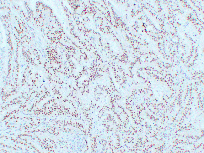 MLH1 Antibody - Colon Carcinoma 4