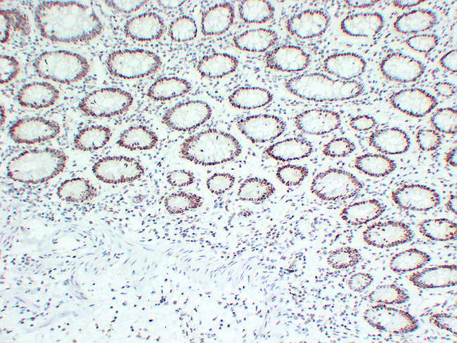 MLH1 Antibody - Colon Carcinoma