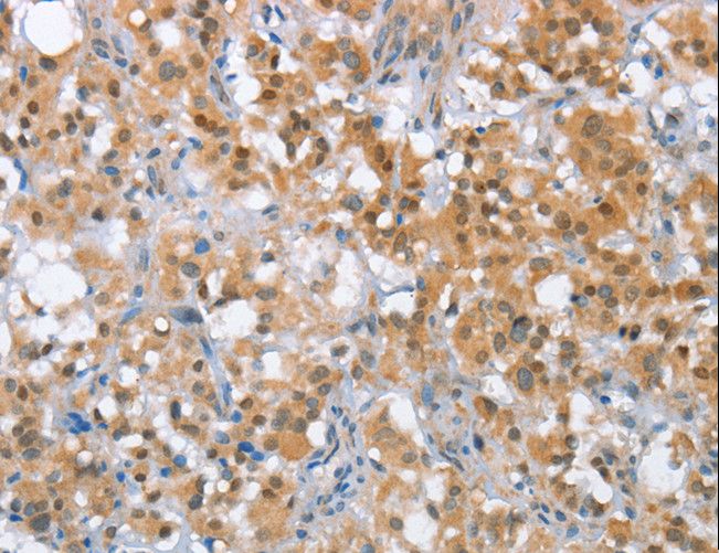 MLH1 Antibody - Immunohistochemistry of paraffin-embedded Human thyroid cancer using MLH1 Polyclonal Antibody at dilution of 1:65.