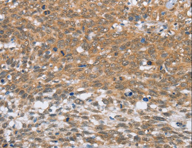 MLH1 Antibody - Immunohistochemistry of paraffin-embedded Human thyroid cancer using MLH1 Polyclonal Antibody at dilution of 1:60.
