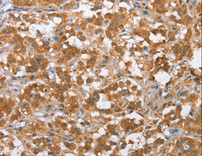 MLH1 Antibody - Immunohistochemistry of paraffin-embedded Human thyroid cancer using MLH1 Polyclonal Antibody at dilution of 1:60.