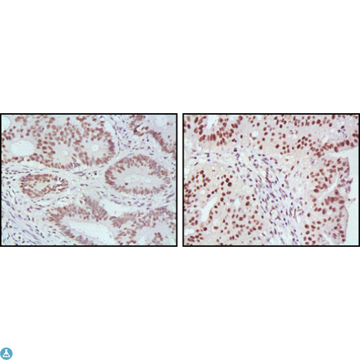 MLH1 Antibody - Immunohistochemistry (IHC) analysis of paraffin-embedded human rectum cancer (left) and ovarian cancer (right) tissues, showing nuclear localization with DAB staining using MLH1 Monoclonal Antibody.