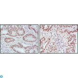 MLH1 Antibody - Immunohistochemistry (IHC) analysis of paraffin-embedded human rectum cancer (left) and ovarian cancer (right) tissues, showing nuclear localization with DAB staining using MLH1 Monoclonal Antibody.