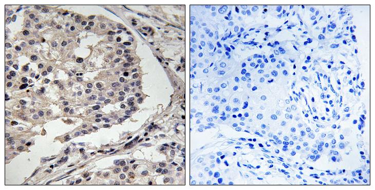 MLK1+2 Antibody - Peptide - + Immunohistochemistry analysis of paraffin-embedded human breast carcinoma tissue using MLK1/2 antibody.