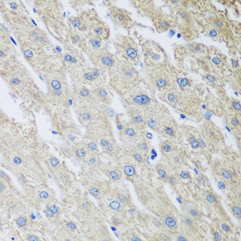 MLKL Antibody - Immunohistochemistry of paraffin-embedded human liver cancer using MLKL antibody at dilution of 1:100 (40x lens).