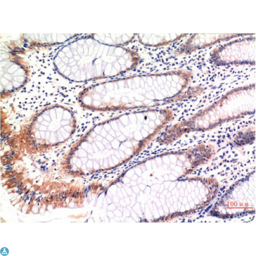 MLKL Antibody - Immunohistochemistry (IHC) analysis of paraffin-embedded Human Colon Carcinoma Tissue using Phospho-MLKL S358 Mouse Monoclonal Antibody diluted at 1:200.