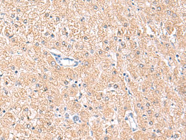 MLKL Antibody - Immunohistochemistry of paraffin-embedded Human liver cancer tissue  using MLKL Polyclonal Antibody at dilution of 1:85(×200)