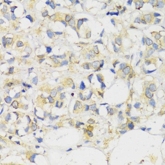 MLKL Antibody - Immunohistochemistry of paraffin-embedded Human breast cancer using MLKL Polyclonal Antibody at dilution of 1:100 (40x lens).
