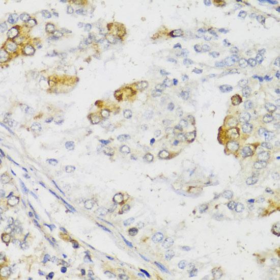 MLKL Antibody - Immunohistochemistry of paraffin-embedded Human uterine cancer using MLKL Polyclonal Antibody at dilution of 1:100 (40x lens).