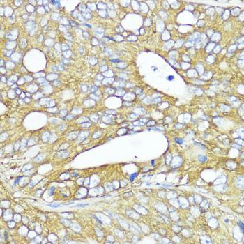 MLKL Antibody - Immunohistochemistry of paraffin-embedded Human colon carcinoma using MLKL Polyclonal Antibody at dilution of 1:200 (40x lens).