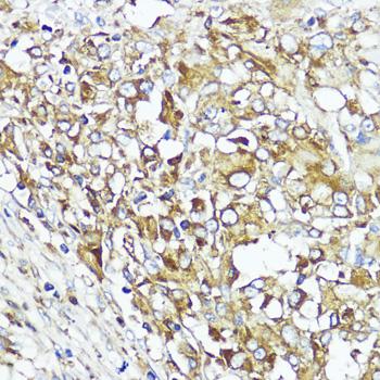 MLKL Antibody - Immunohistochemistry of paraffin-embedded Human liver cancer using MLKL Polyclonal Antibody at dilution of 1:200 (40x lens).