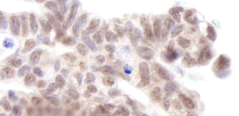 MLLT3 / AF9 Antibody - Detection of Human AF9 by Immunohistochemistry. Sample: FFPE section of human ovarian carcinoma. Antibody: Affinity purified rabbit anti-AF9 used at a dilution of 1:250.