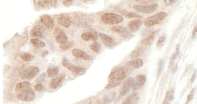 MLLT3 / AF9 Antibody - Detection of Human AF9 by Immunohistochemistry. Sample: FFPE section of human ovarian carcinoma. Antibody: Affinity purified rabbit anti-AF9 used at a dilution of 1:1000 (1 ug/ml).
