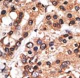 MLLT3 / AF9 Antibody - Formalin-fixed and paraffin-embedded human cancer tissue reacted with the primary antibody, which was peroxidase-conjugated to the secondary antibody, followed by AEC staining. This data demonstrates the use of this antibody for immunohistochemistry; clinical relevance has not been evaluated. BC = breast carcinoma; HC = hepatocarcinoma.