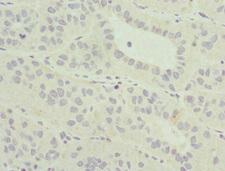 MLLT3 / AF9 Antibody - Immunohistochemistry of paraffin-embedded human liver cancer at dilution 1:100