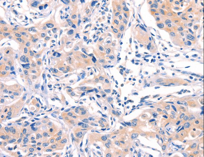 MLLT4 / Afadin Antibody - Immunohistochemistry of paraffin-embedded Human lung cancer using MLLT4 Polyclonal Antibody at dilution of 1:40.