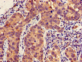 MLLT4 / Afadin Antibody - Immunohistochemistry of paraffin-embedded human pancreatic cancer using MLLT4 Antibody at dilution of 1:100