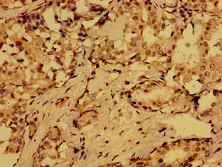 MLN / Motilin Antibody - Immunohistochemistry of paraffin-embedded human breast cancer at dilution of 1:100