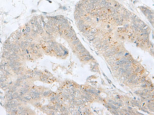 MLNR/GPR38/Motilin Receptor Antibody - Immunohistochemistry of paraffin-embedded Human colorectal cancer tissue  using MLNR Polyclonal Antibody at dilution of 1:35(×200)