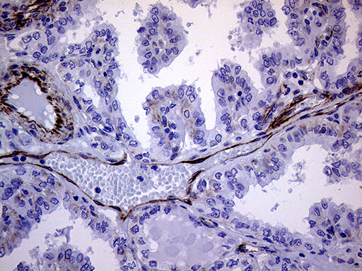 MLPH / Melanophilin Antibody - Immunohistochemical staining of paraffin-embedded Carcinoma of Human thyroid tissue using anti-MLPH mouse monoclonal antibody. (Heat-induced epitope retrieval by 1mM EDTA in 10mM Tris buffer. (pH8.5) at 120°C for 3 min. (1:500)