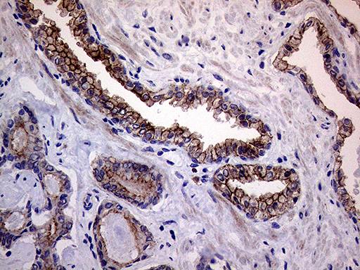 MLPH / Melanophilin Antibody - Immunohistochemical staining of paraffin-embedded Carcinoma of Human prostate tissue using anti-MLPH mouse monoclonal antibody. (Heat-induced epitope retrieval by 1mM EDTA in 10mM Tris buffer. (pH8.5) at 120°C for 3 min. (1:500)