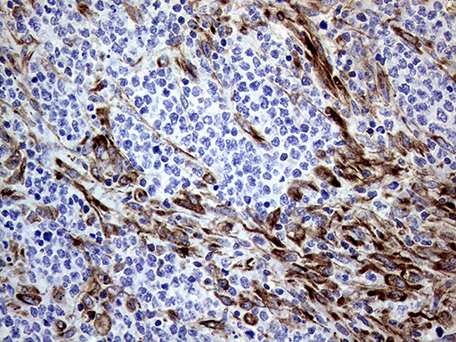 MLPH / Melanophilin Antibody - Immunohistochemical staining of paraffin-embedded Human lymphoma tissue using anti-MLPH mouse monoclonal antibody. (Heat-induced epitope retrieval by 1mM EDTA in 10mM Tris buffer. (pH8.5) at 120°C for 3 min. (1:500)