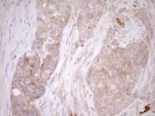 MLPH / Melanophilin Antibody - Immunohistochemical staining of paraffin-embedded Adenocarcinoma of Human endometrium tissue using anti-MLPH mouse monoclonal antibody. (Heat-induced epitope retrieval by 1mM EDTA in 10mM Tris buffer. (pH8.5) at 120°C for 3 min. (1:150)