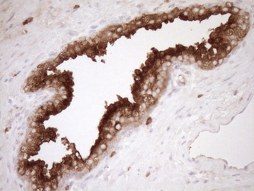 MLPH / Melanophilin Antibody - Immunohistochemical staining of paraffin-embedded Carcinoma of Human prostate tissue using anti-MLPH mouse monoclonal antibody. (Heat-induced epitope retrieval by 1mM EDTA in 10mM Tris buffer. (pH8.5) at 120°C for 3 min. (1:150)
