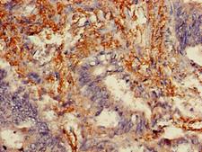 MLPH / Melanophilin Antibody - Immunohistochemistry of paraffin-embedded human colon cancer using MLPH Antibody at dilution of 1:100
