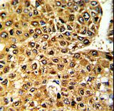 MLX / TCFL4 Antibody - Formalin-fixed and paraffin-embedded human hepatocarcinoma with MLX Antibody , which was peroxidase-conjugated to the secondary antibody, followed by DAB staining. This data demonstrates the use of this antibody for immunohistochemistry; clinical relevance has not been evaluated.