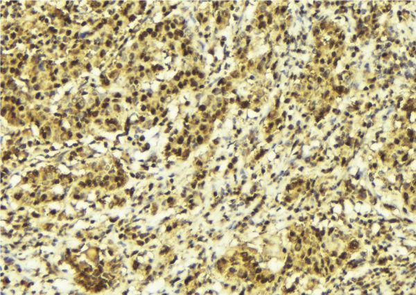 MLXIP / MONDOA Antibody - 1:100 staining human breast carcinoma tissue by IHC-P. The sample was formaldehyde fixed and a heat mediated antigen retrieval step in citrate buffer was performed. The sample was then blocked and incubated with the antibody for 1.5 hours at 22°C. An HRP conjugated goat anti-rabbit antibody was used as the secondary.