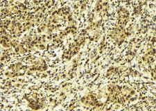 MLXIP / MONDOA Antibody - 1:100 staining human breast carcinoma tissue by IHC-P. The sample was formaldehyde fixed and a heat mediated antigen retrieval step in citrate buffer was performed. The sample was then blocked and incubated with the antibody for 1.5 hours at 22°C. An HRP conjugated goat anti-rabbit antibody was used as the secondary.