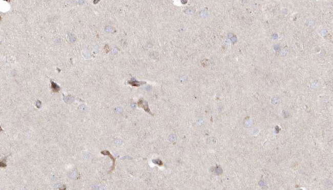 MLYCD / MCD Antibody - 1:100 staining human brain carcinoma tissue by IHC-P. The sample was formaldehyde fixed and a heat mediated antigen retrieval step in citrate buffer was performed. The sample was then blocked and incubated with the antibody for 1.5 hours at 22°C. An HRP conjugated goat anti-rabbit antibody was used as the secondary.