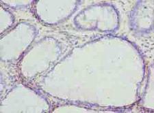 MLZE Antibody - Immunohistochemistry of paraffin-embedded human rectal cancer using antibody at dilution of 1:100.